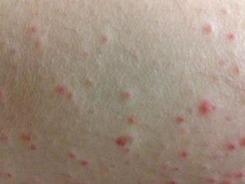 紫癜可以吃瓜吗,瓜类食物的适宜摄入